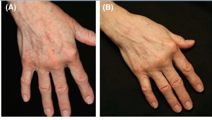 Mulher de 72 anos no início do estudo (A) e 3 meses (B) após série de três peelings químicos com TCA + AG.