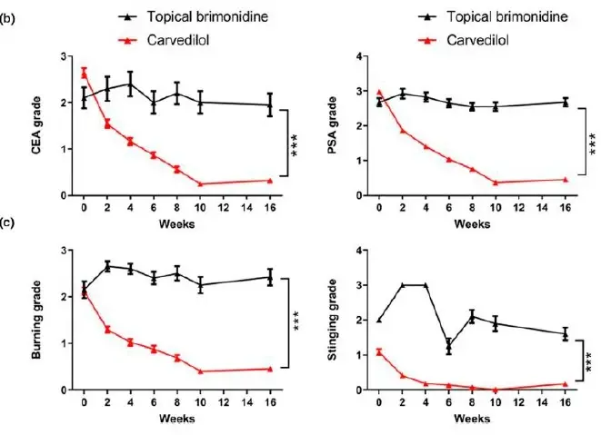 Quatro gráficos comparando a eficácia do carvedilol e da brimonidina tópica no tratamento de ETR ao longo de 16 semanas.