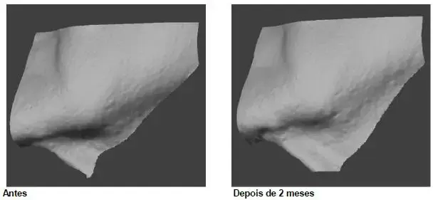 reconstrução 3D da região da bochecha inferior