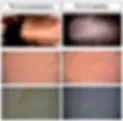 Comparação fotográfica do uso de cetirizina no quadro de alopecia.