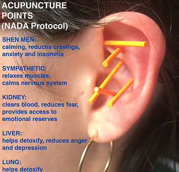 Acupuncture NADA Protocol