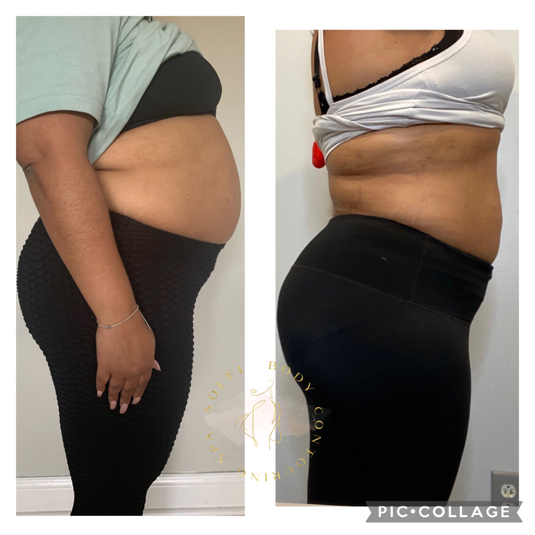 LIPO 360 (3 SESSIONS)
