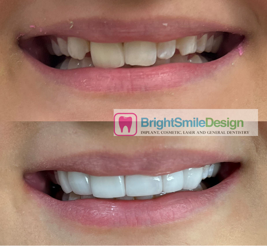Dental Veneers before and after 6 Howell Nj and Red Bank NJ Brooklyn NYC