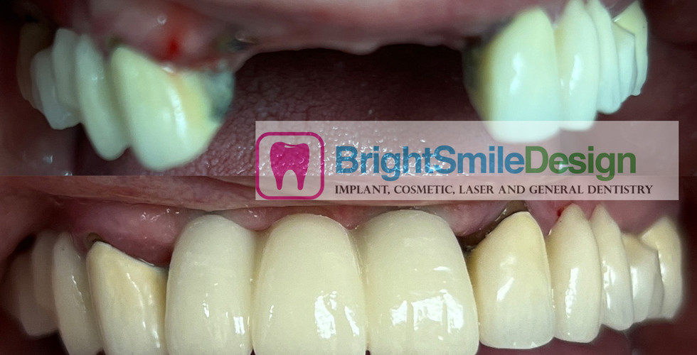 Dental Implants in NYC & NJ