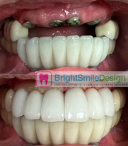 Dental Implants in NYC & NJ