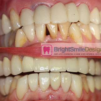 Dental Veneers in NYC