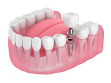 Dental Implants Solutions