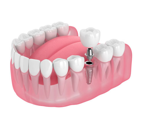 Dental Implants Solutions
