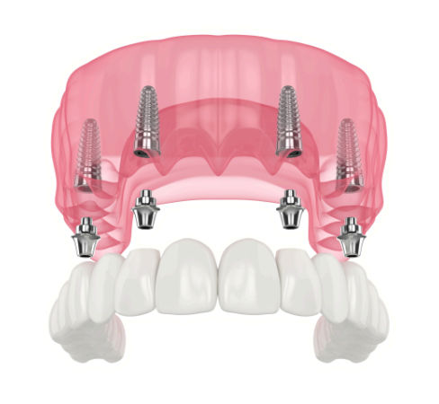 All On Four Dental Implant Bridge.