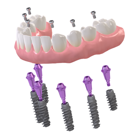 Clinica dental Dentica Implantes