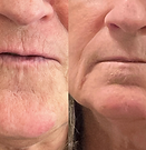 Before and After  The Wrinkle Cure www.RedeemAndRenew.com