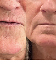 Before and After  The Wrinkle Cure www.RedeemAndRenew.com