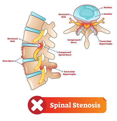 spinalstinosis.jpg