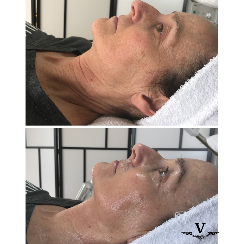 results by skin x chelsea with vanity technologies