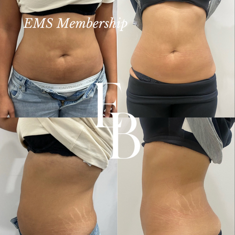 EMS body sculpting Membership in Ringwood & Croydon
