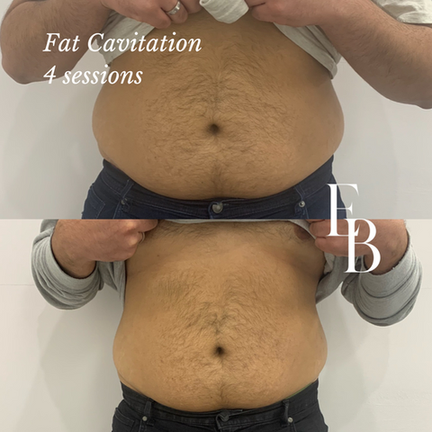 Fat Cavitation from $55 in Ringwood 
