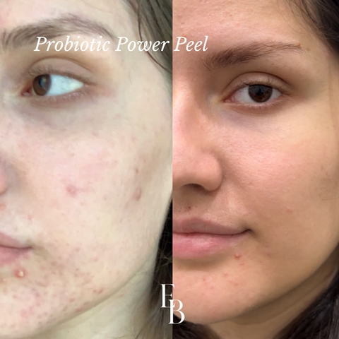 Probiotic Power Peel in Croydon
