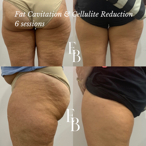 Fat Cavitation & Cellulite Reduction in Doncaster
