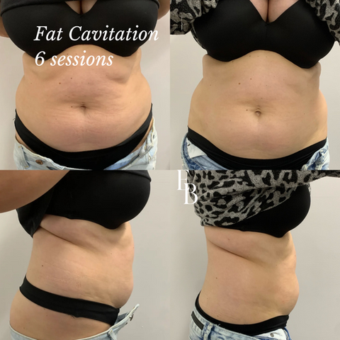 Fat Cavitation in Doncaster
