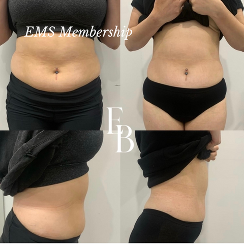 EMSculpt fat reduction Membership in Croydon
