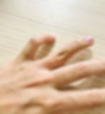 Swan Neck Deformity