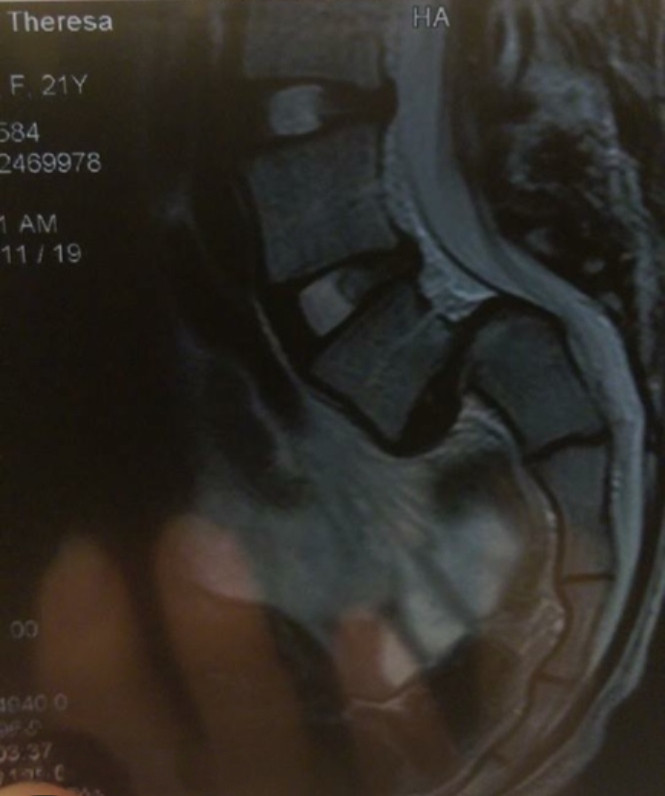 x-ray of my spine with grade 4 spondylolisthesis
