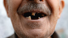 I Dream My Teeth Fall Out--What Does It Mean?