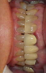 Before Denture Treatment