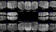 How Often Should I Take Dental X-rays?