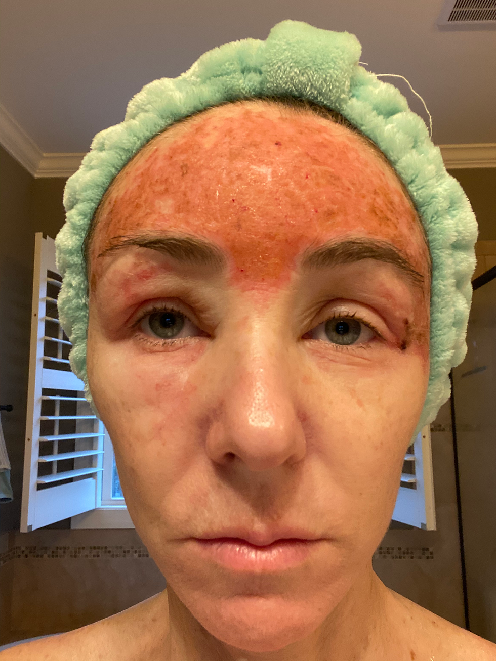 My Skin Cancer Journey: Prevention, Treatments, and Lessons Learned