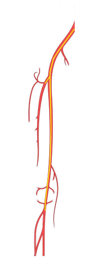 lesion recanalisazion.png