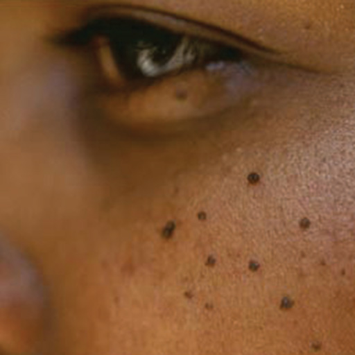 Morgan Rash Skin This Common Condition is Famously Known to Morgan Freeman