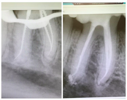 Root Canal Treatment