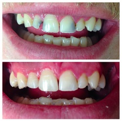 Restorative Treatment