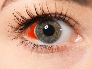 saiba mais sobre a hemorragia subconjuntival