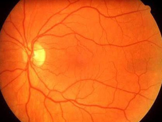 Exame oftalmológico antecipa diagnóstico de doenças