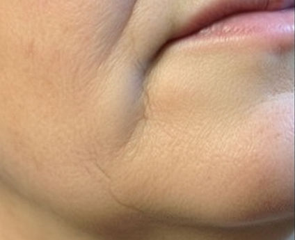 Microneedling results