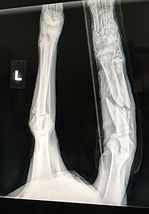 Xray Example of injury.JPG