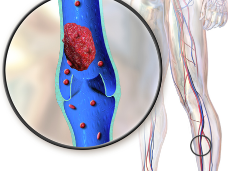 O que é Trombose Venosa Profunda (TVP) e tratamentos