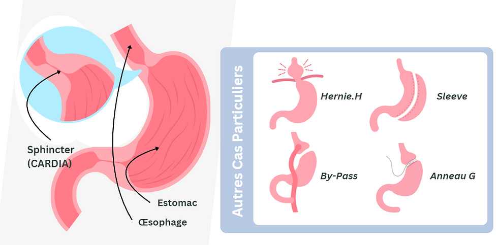Causes éventuelles de remonté acides