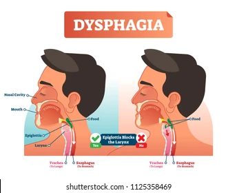 Diagram of dysphagia