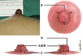 breastsurgery_0403.jpg