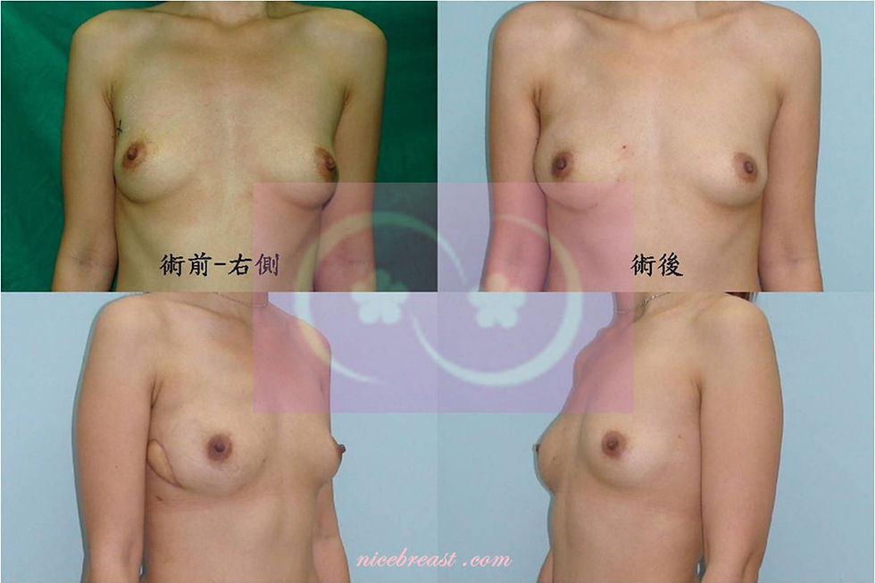 深下腹動脈穿通枝皮瓣 (3)