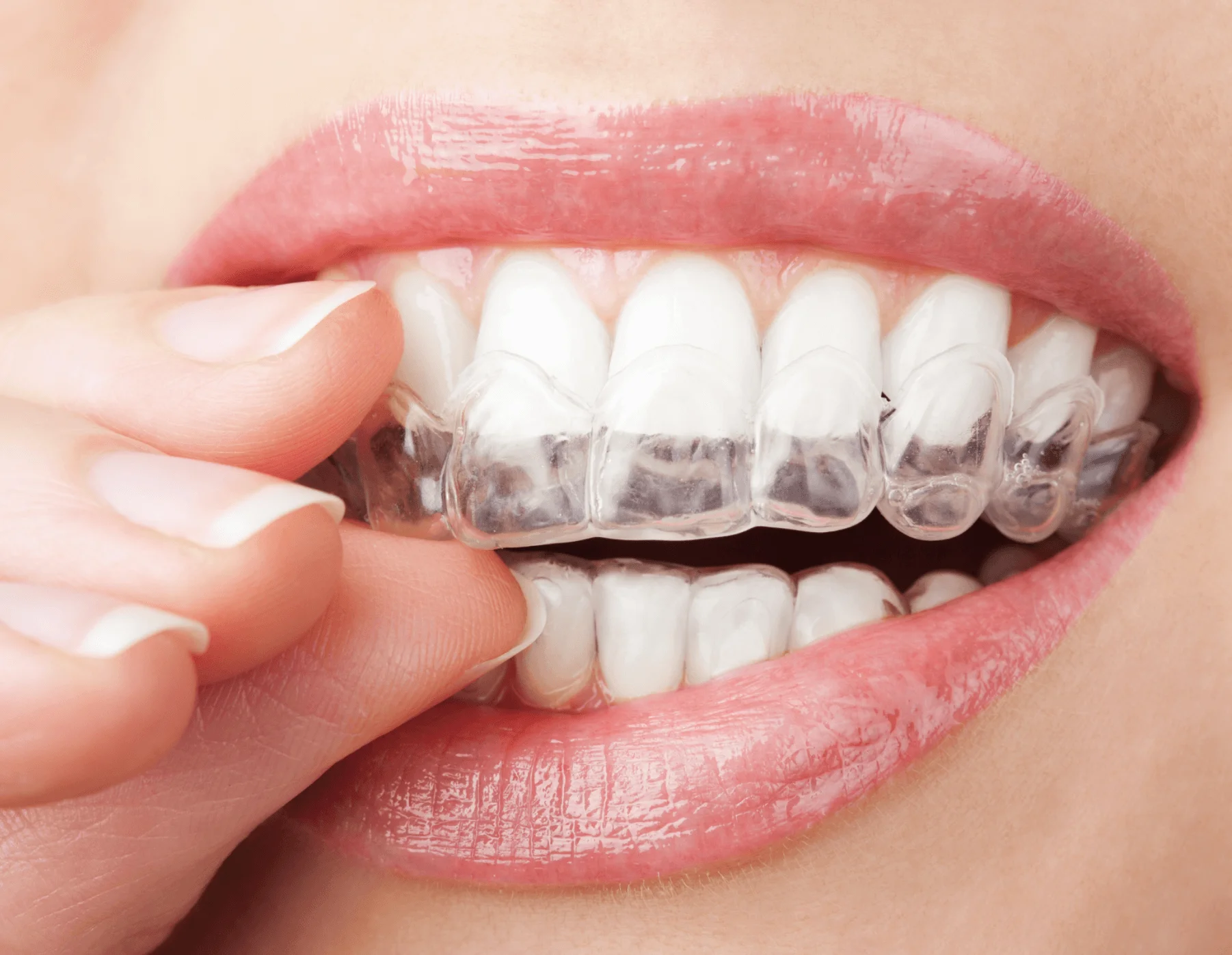 Smile Aligner'ın Hizmetleriyle Gülüşünüzdeki Farkı Hissedin.