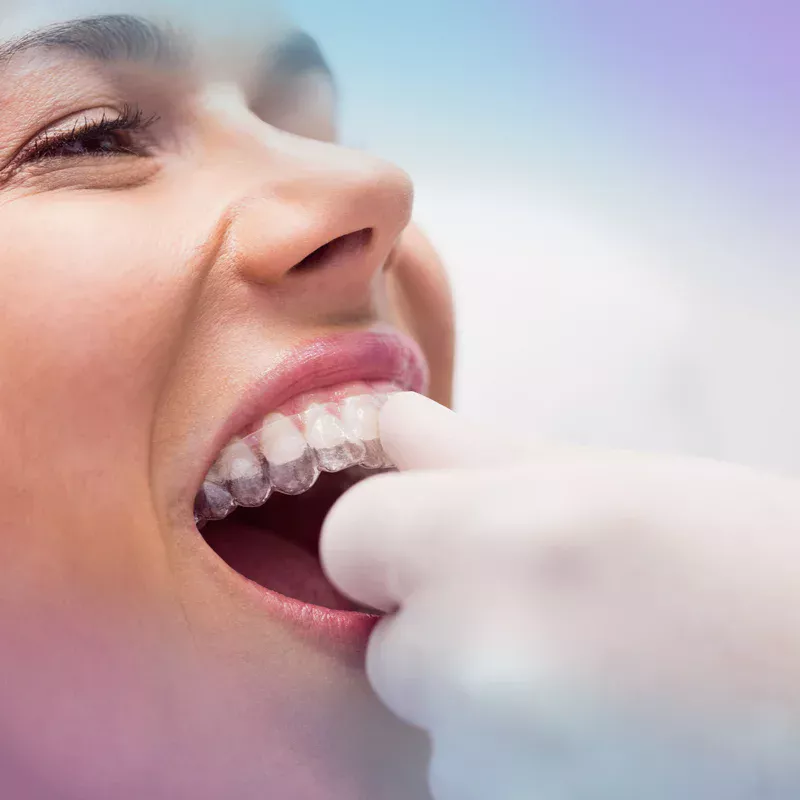 Smile Aligner olarak, şeffaf plak tedavisi sunuyoruz.