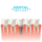 Dental Bridge Dentist Brookfield IL 60513