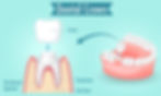 Dental crowns are a type of dental restoration that covers a damaged tooth or a dental implant. They are also known as caps, and are used to restore the shape, size, strength, and appearance of a tooth.