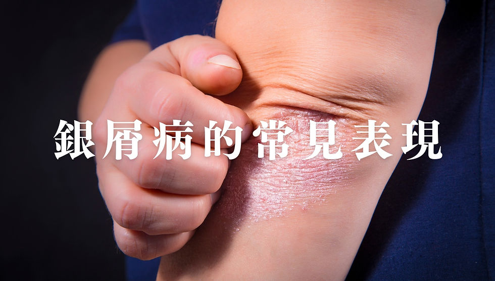 銀屑病的常見表現