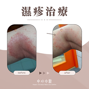 濕疹治療