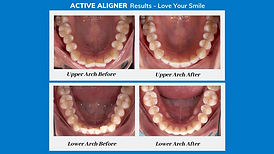 active-aligners-05.jpg
